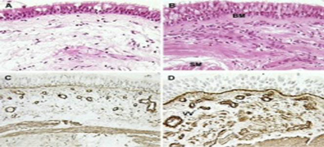 The airway epithelium dysfunction in the pathogenesis of asthma: The ...