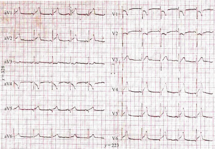 Marked Elevation Of Troponin I Without Wall Motion Abnormality In A Patient With Myocarditis 