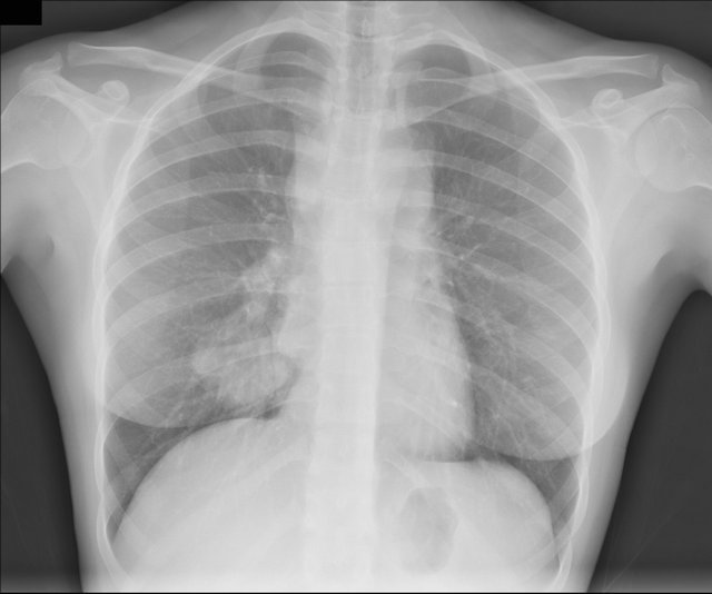 Hodgkins Lymphoma Presenting As Chest Pain