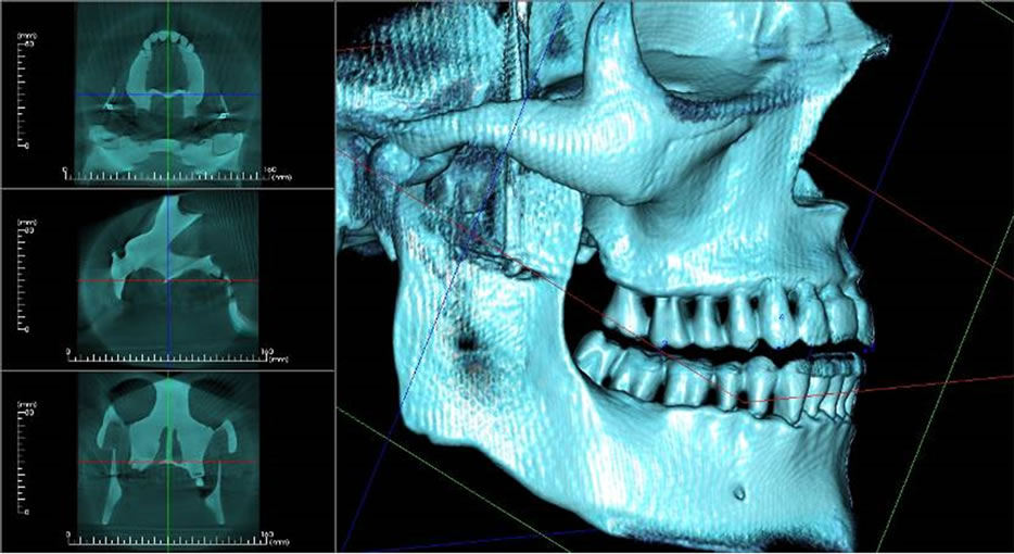 InterOcclusal Separation in CBCT Imaging Rationale and Method