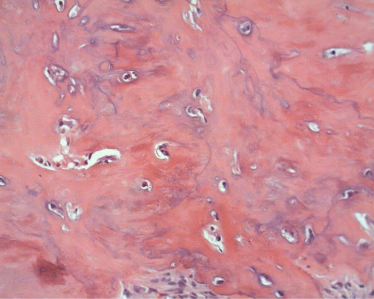 Mandibular cementoblastoma Case report