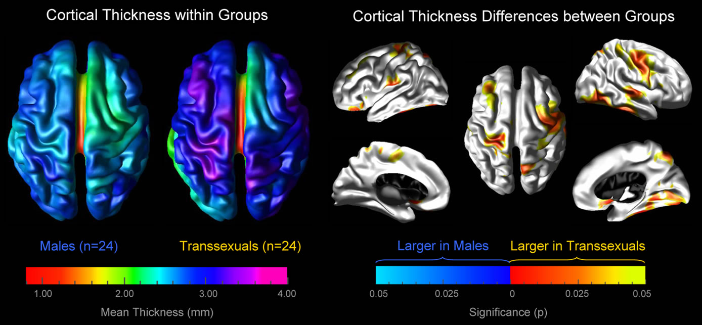 Increased Cortical Thickness In Male To Female Transsexualism