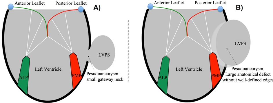 Left Ventricle Postinfarction Pseudoaneurysm: Anatomical Forms and Surgical Management