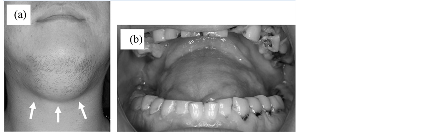 A Case Of Giant Epidermoid Cyst In The Floor Of The Mouth That Caused