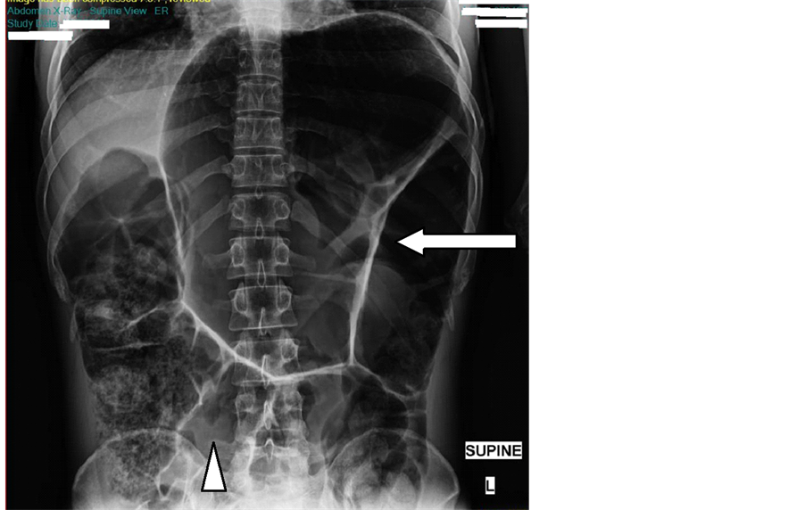 Underdiagnosed Distal Colonic Volvuli on MDCT Imaging