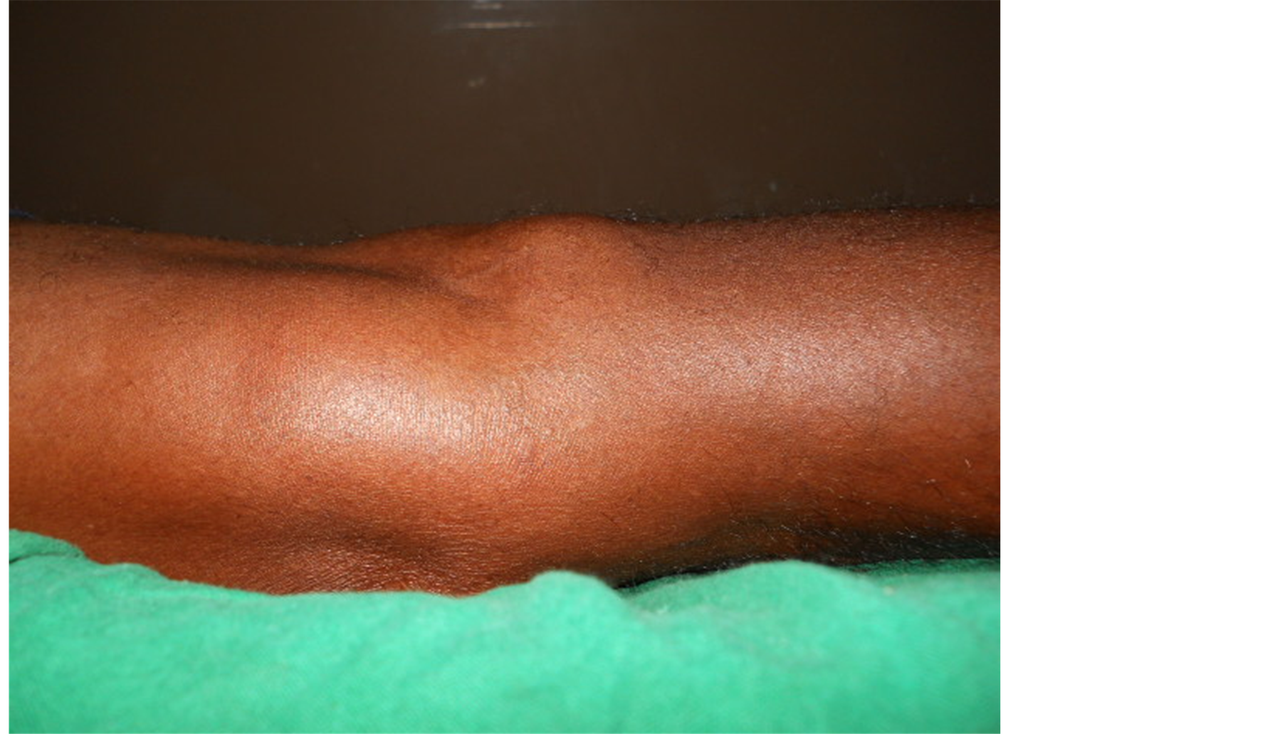 Tuberculous Arthritis Of Knee Presenting As Bakers Cyst A Case Report