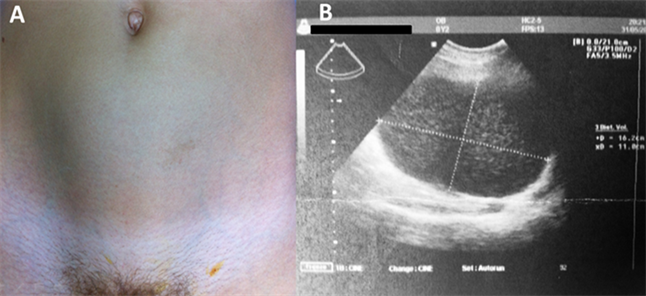 Robotic Removal of a Hypogastric Splenic Cyst. A Case Report and Review