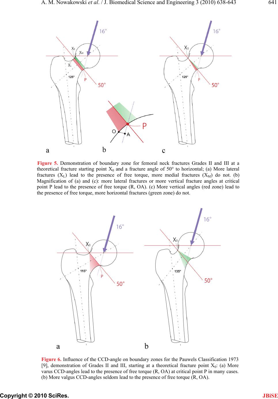 Classification of femoral neck fractures according to pauwels