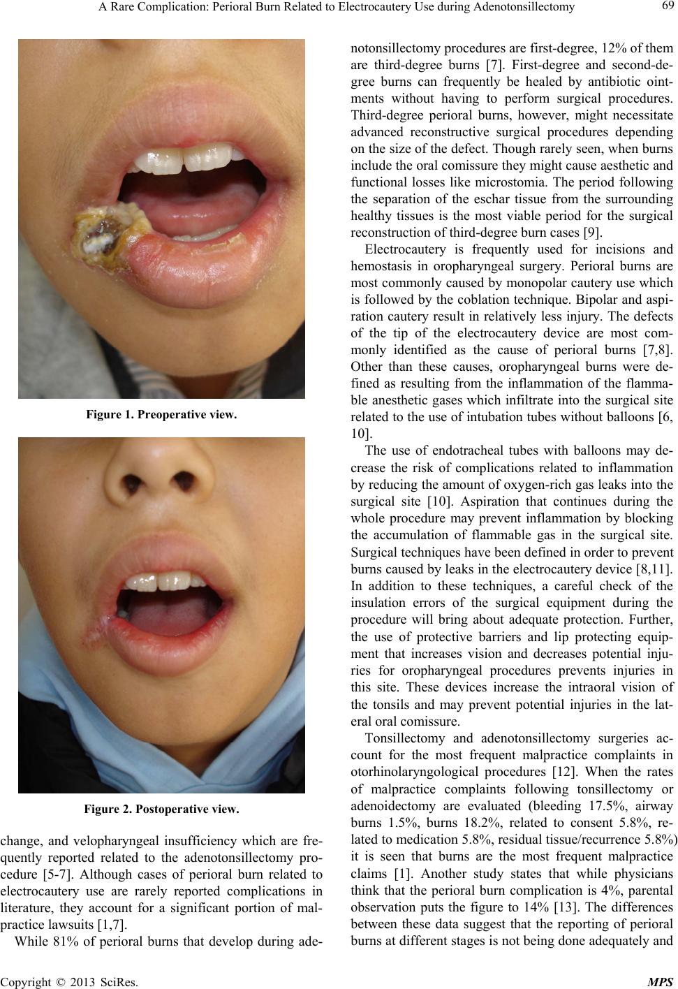 A Rare Complication Perioral Burn Related to Electrocautery Use during