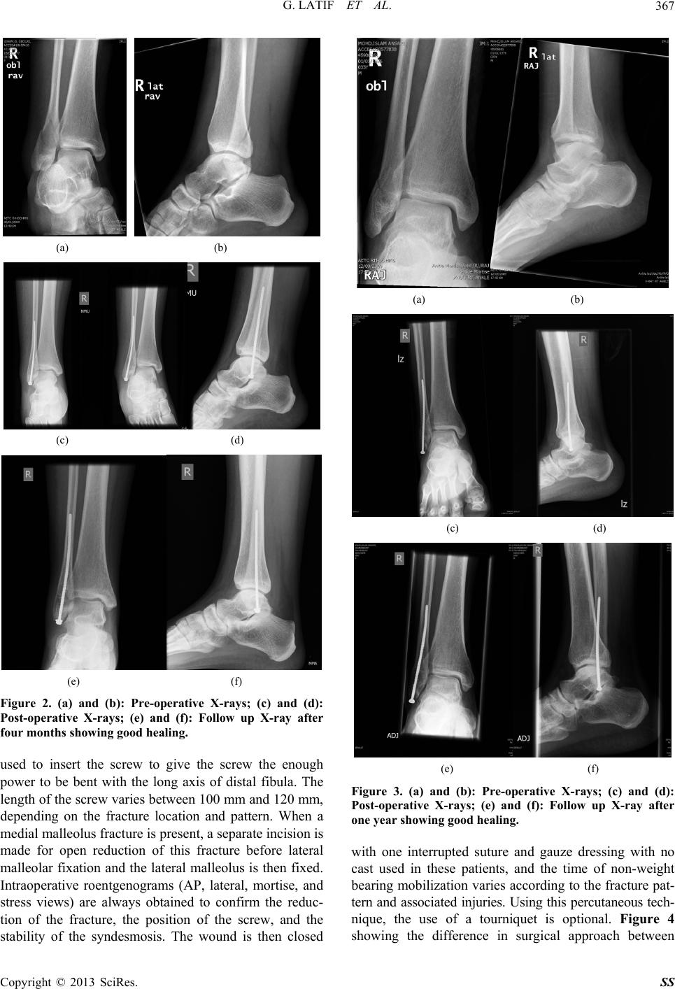 The Effect of Percutaneous Screw Fixation of Lateral Malleolus on Ankle